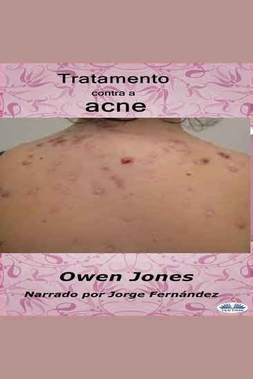 Tratamiento del acné - cover