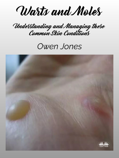 Warts And Moles - Understanding And Managing These Common Skin Conditions - cover