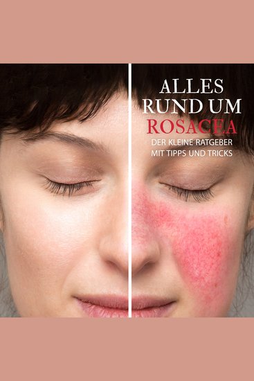 Alles Rund um Rosacea - Der kleine Ratgeber mit Tipps und Tricks - cover