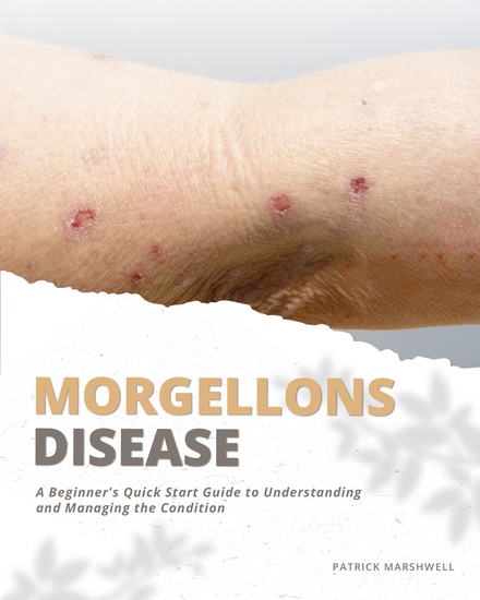 Morgellons Disease - A Beginner's Quick Start Guide to Understanding and Managing the Condition - cover